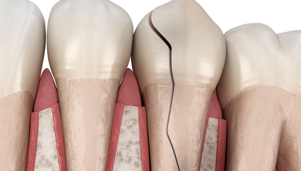 Cracked tooth