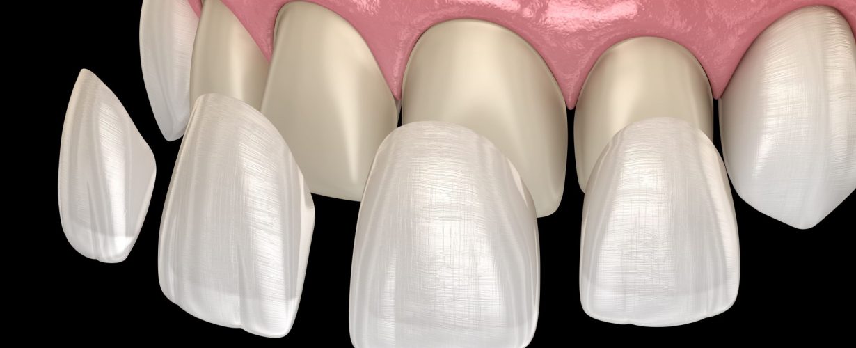 Dental Porcelain Veneers