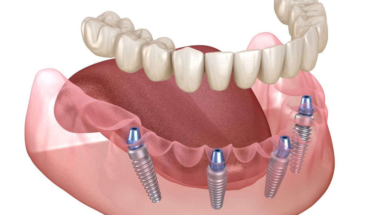 Dental Implants