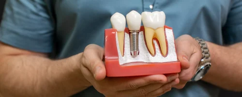 closeup-male-dentist-doctor-hands-with-dental-implant-model-as-teaching-aid-scaled
