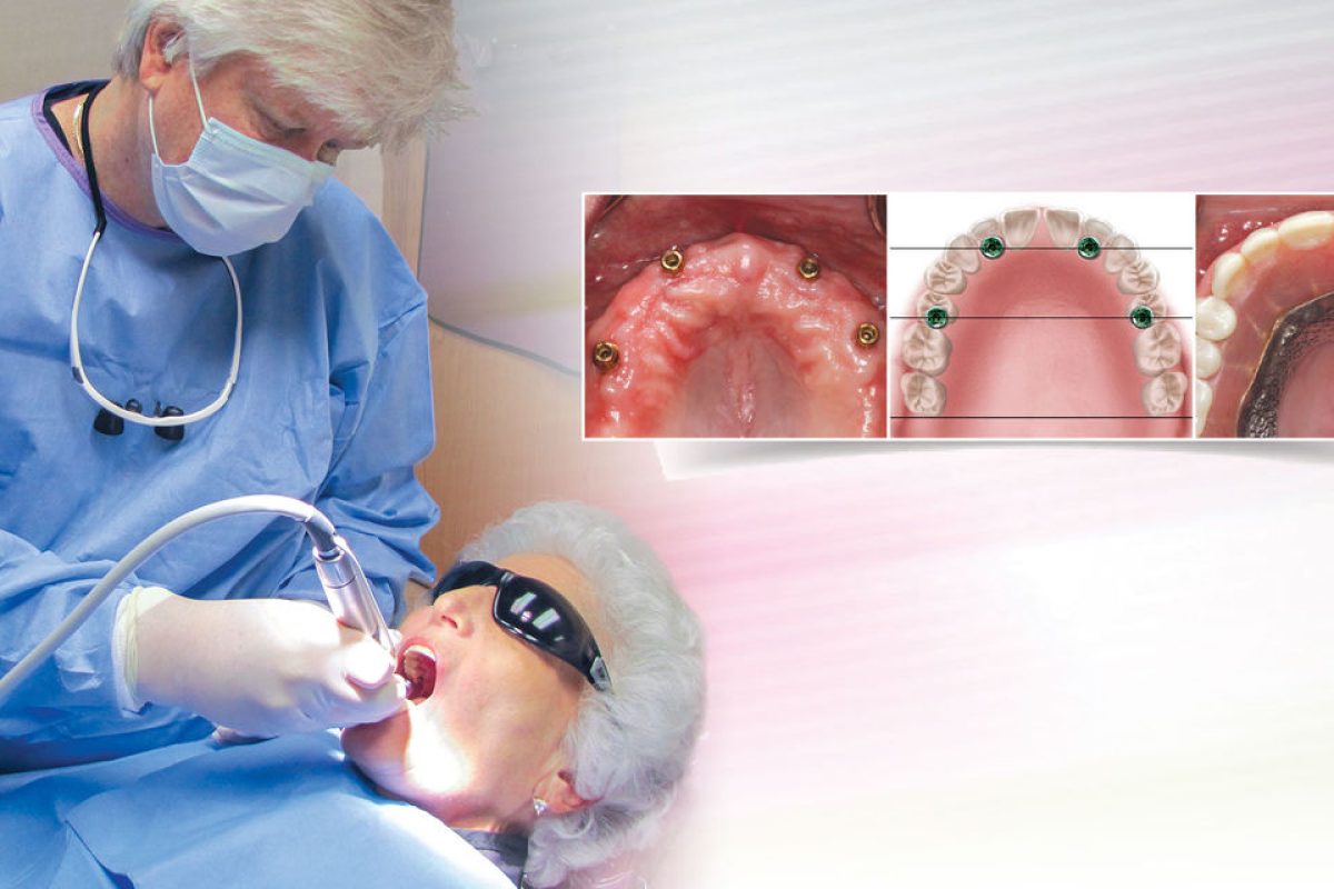 hd-cm1004-implant-dentures