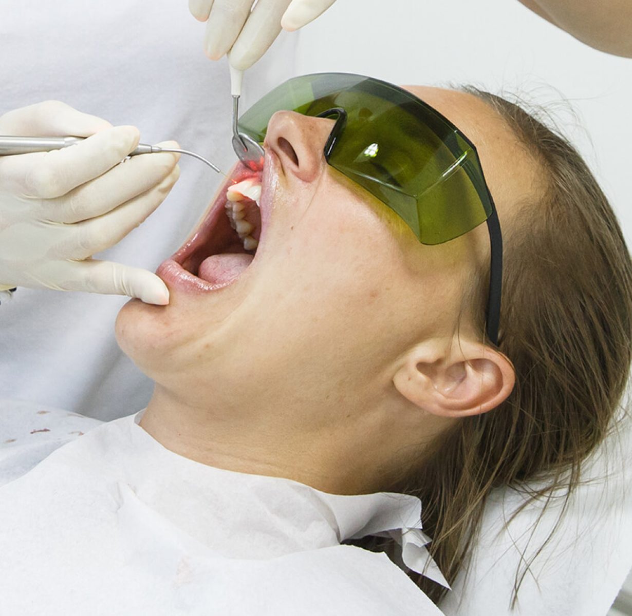 laser-assisted-periodontal-therapy-colorado-springs-co